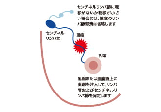 センチネルリンパ節生検
