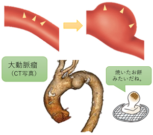 1.大動脈瘤ってどんな病気？