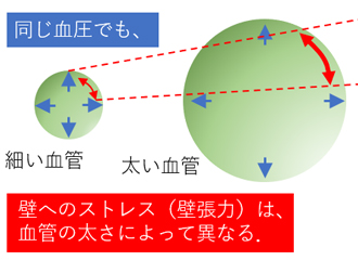1.瘤の大きさと壁へのストレス
