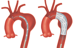 ステントグラフト治療