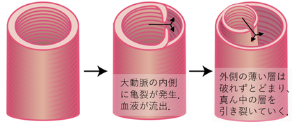 急性大動脈解離