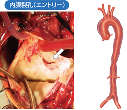 急性大動脈解離