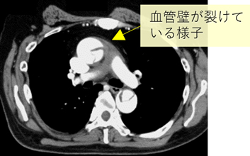 急性大動脈解離