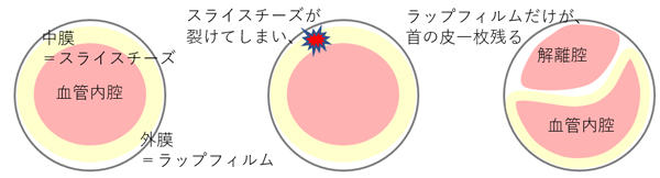 大動脈解離を例えると