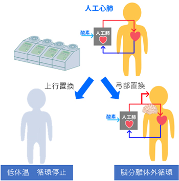 2.人工心肺装置、低体温手術
