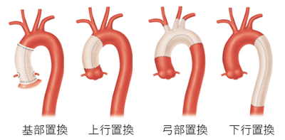 人工血管置換術