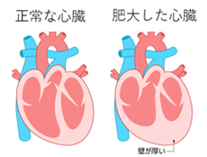 心肥大の問題点