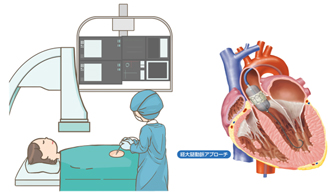 3.カテーテル治療