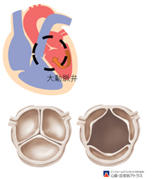 1.大動脈弁とは