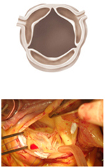 心臓の出口が狭いと、どんな負担になる？