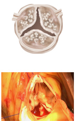 心臓の出口が狭いと、どんな負担になる？