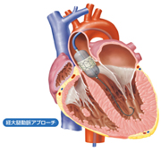 カテーテル治療