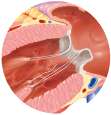 2.僧帽弁閉鎖不全症とは