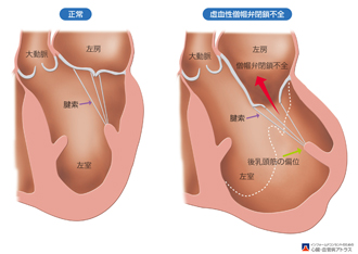 2.僧帽弁閉鎖不全症とは