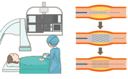 カテーテル治療(PCI)