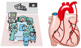 バイパス手術(CABG)