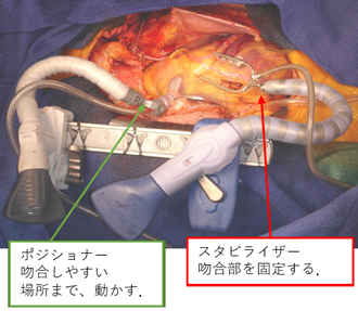 オフポンプ手術ってなんですか？