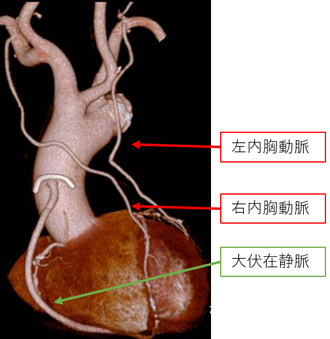 オフポンプ手術ってなんですか？
