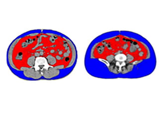 メタボリック症候群