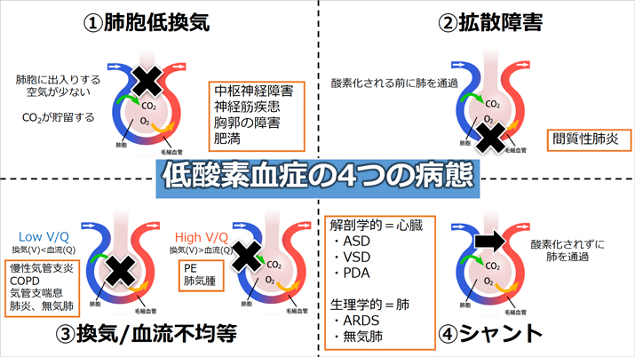 低酸素血症の4病態