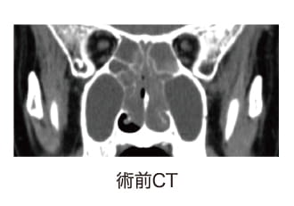 術前CT