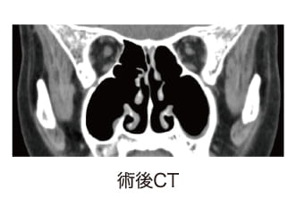 術後CT