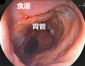 食道と胃管