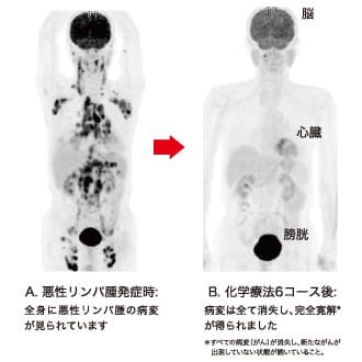 悪性リンパ腫治療前後でのPET-CT画像