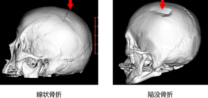 頭蓋骨骨折