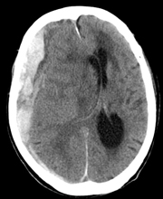 急性硬膜下血種