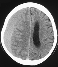 慢性硬膜下血腫