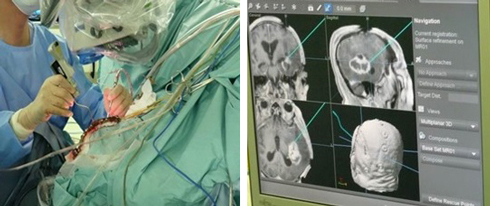 ストライカー社ナビゲーションシステム使用例
