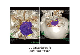 3D-CTの画像を使った術前シミュレーション
