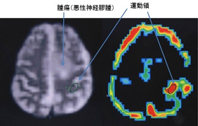 術前MRIでの腫瘍の固定：機能的