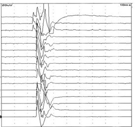 術中神経機能モニタリング