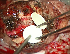 術中神経機能モニタリング