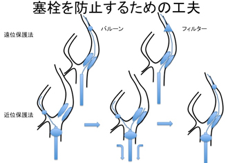 脳血管障害にあるステント治療の図