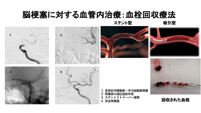 脳血管障害にある血栓回収療法図