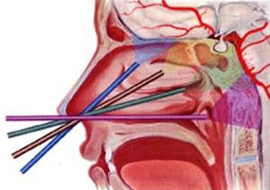 下垂体腫瘍および近傍疾患