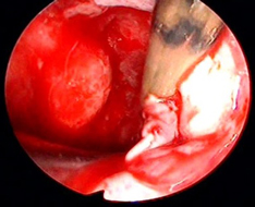 下垂体腫瘍および近傍疾患