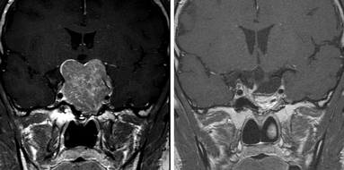 下垂体腫瘍および近傍疾患