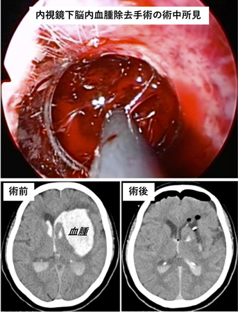 神経内視鏡手術