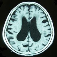MRIの水平断と冠状断を示します