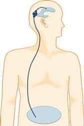 脳室－腹腔シャント術