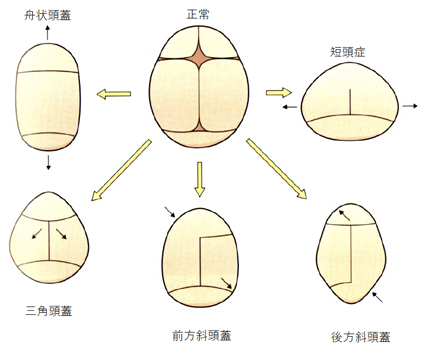 頭蓋骨縫合早期癒合症