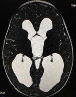 鞍上部くも膜嚢胞