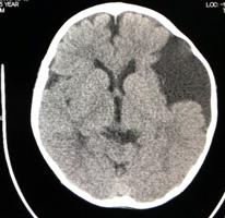 中頭蓋窩くも膜嚢胞