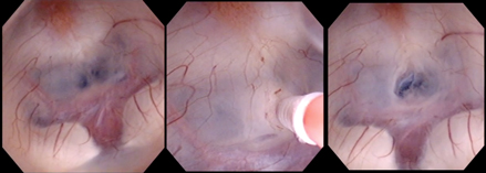 神経内視鏡を用いた第三脳室底開窓術
