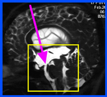 神経内視鏡を用いた第三脳室底開窓術