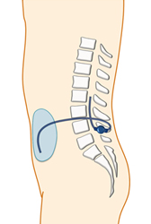 腰椎－腹腔シャント術